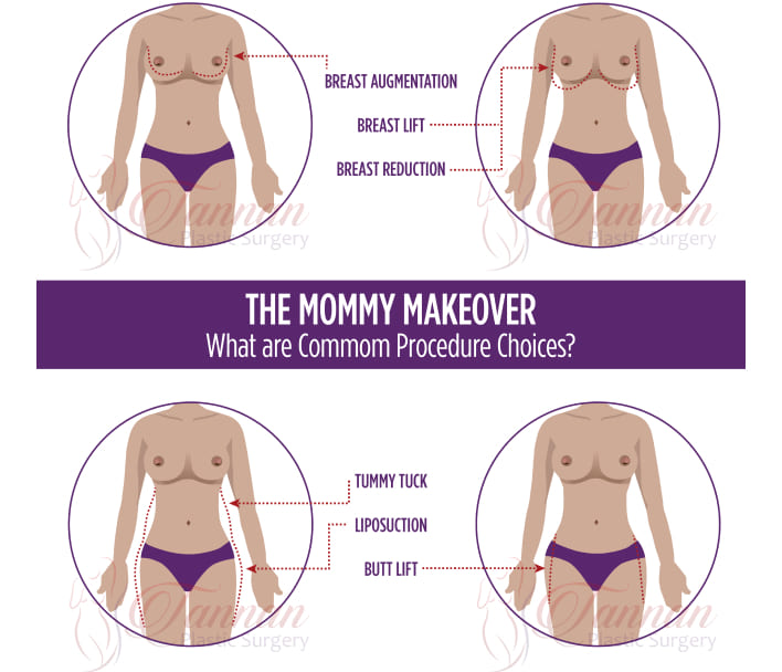 Mommy Makeover Surgery with Dr. Kena Patel